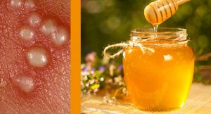 بهترین نوع عسل برای درمان زونا کدام است؟
